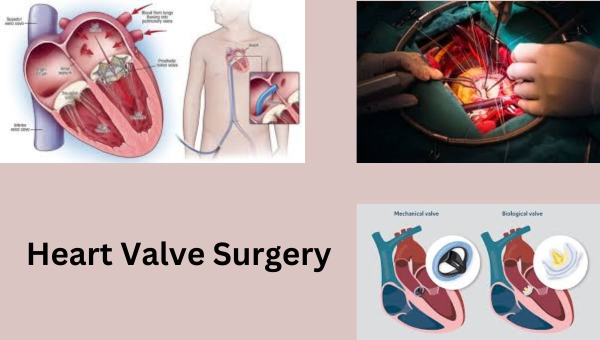 Heart Valve Surgery