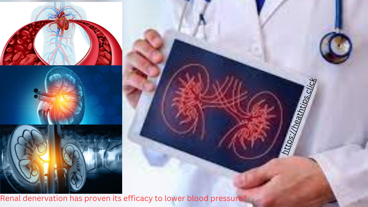 Renal denervation has proven its efficacy to lower blood pressure?